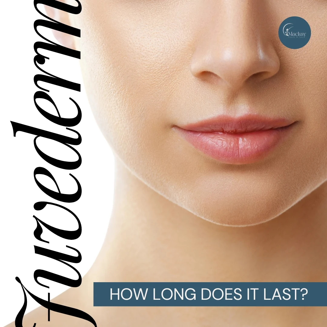 How Long Does Juvederm Last?: illustration from the practice guide