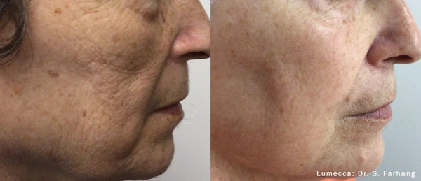 Lumecca IPL before and after example 35