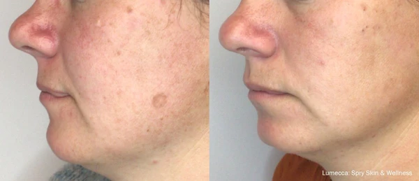 Lumecca IPL before and after example 12