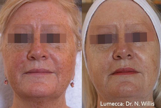 Lumecca IPL before and after example 5