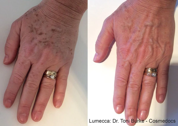 Lumecca IPL before and after example 3