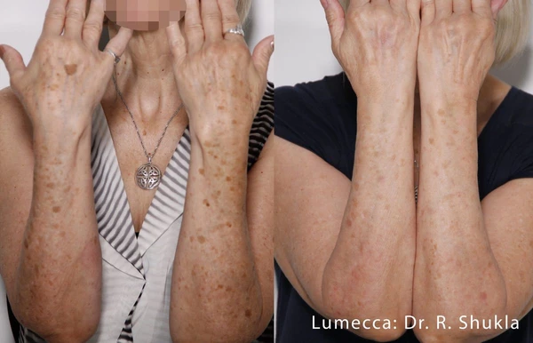 Lumecca IPL before and after example 36