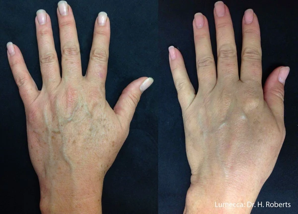 Lumecca IPL before and after example 39