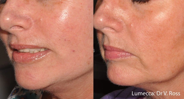 Lumecca IPL before and after example 24