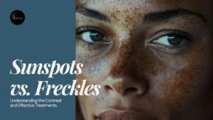 Sun Spots vs Freckles – What is the Difference?