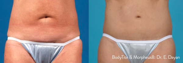 Morpheus8 body before and after example 19