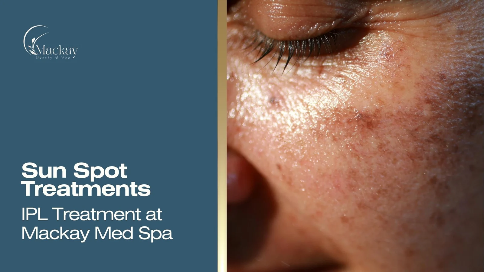 Everything You Should Know About Sun Spot Removal & Reduction with IPL Treatments
