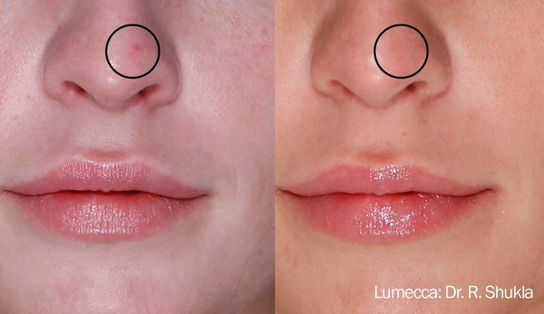 Lumecca IPL before and after example 22
