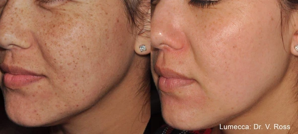 Lumecca IPL before and after example 25