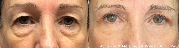 Morpheus8 eyes before and after example 1
