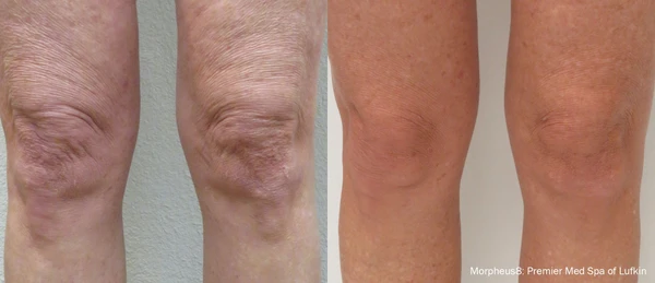 Morpheus8 body before and after example 15