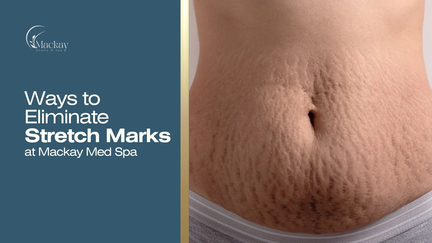 How to Get Rid of Stretch Marks
