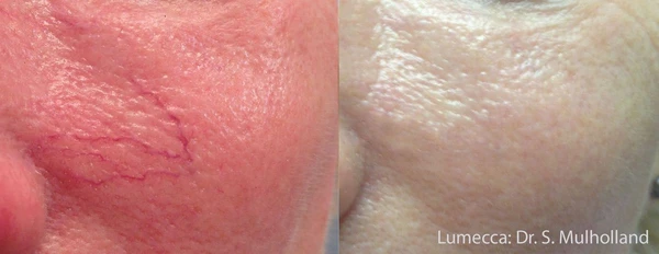 Lumecca IPL before and after example 32