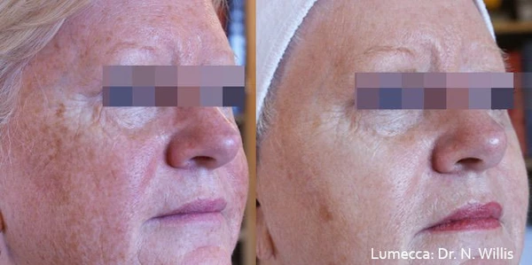 Lumecca IPL before and after example 6