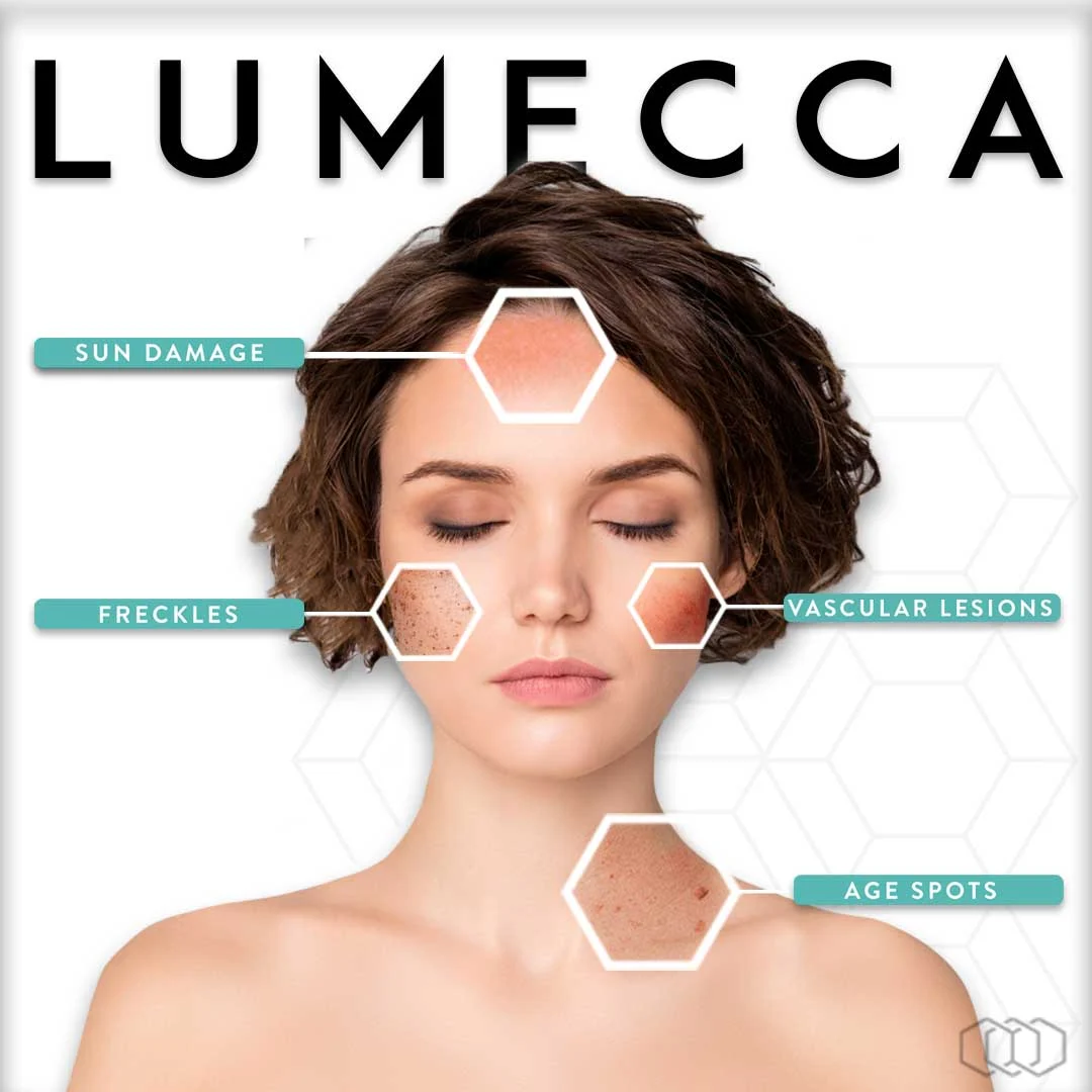 Lumecca IPL: illustration from the practice guide