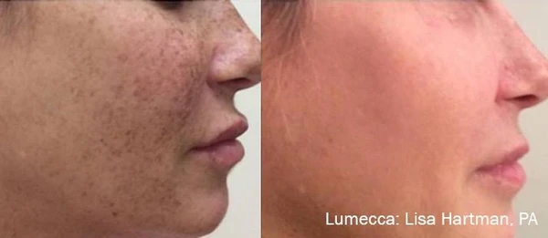 Lumecca IPL before and after example 34