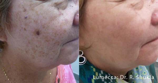 Lumecca IPL before and after example 15