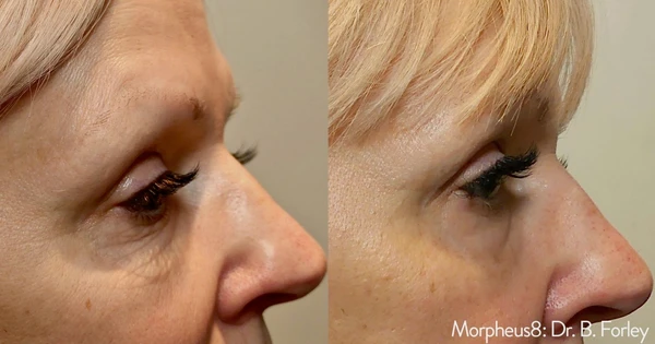 Morpheus8 eyes before and after example 5