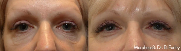 Morpheus8 eyes before and after example 4
