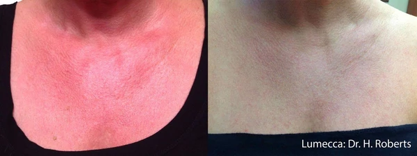 Lumecca IPL before and after example 29