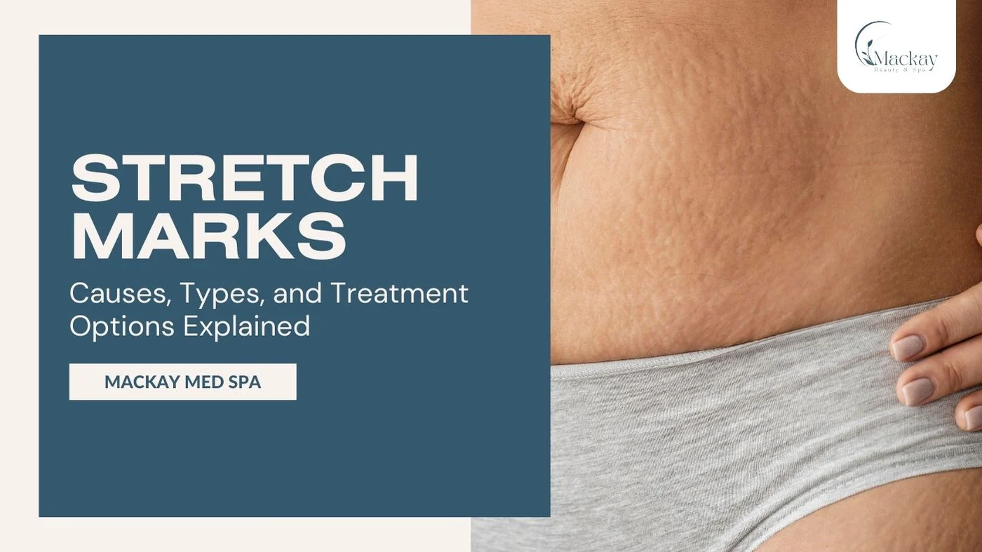 What Causes Stretch Marks and How They Can Be Treated