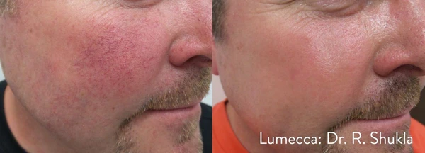 Lumecca IPL before and after example 18