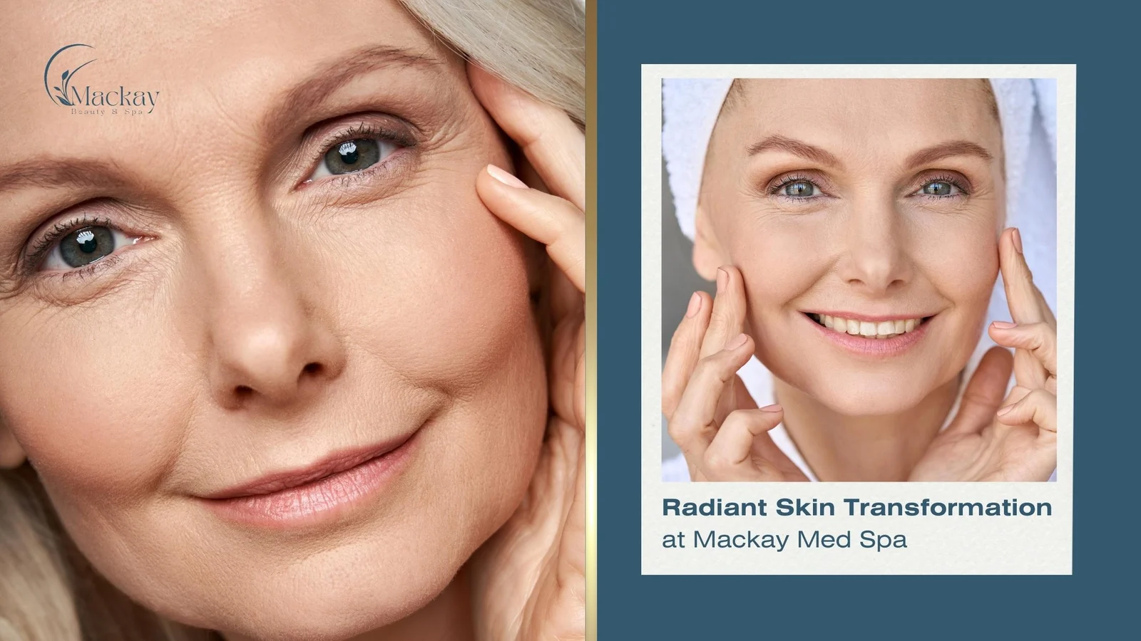 How Long Does Microneedling Last?