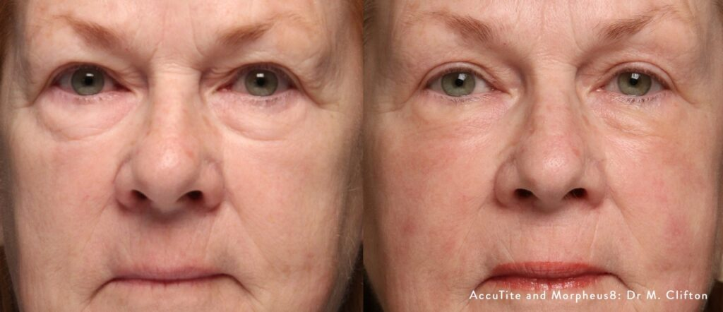 accutite-morpheus8-before-after-dr-m-clifton-preview-1 Large