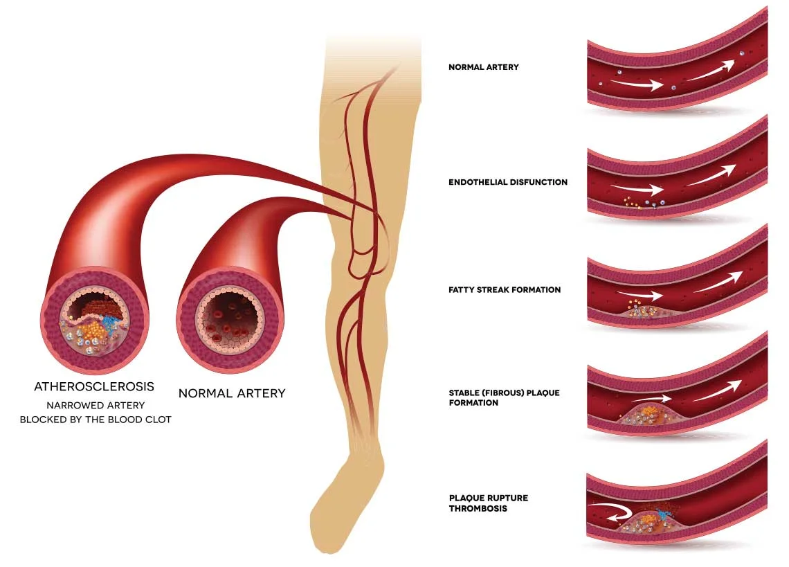 leg blood clot illustration with levels of venous disease