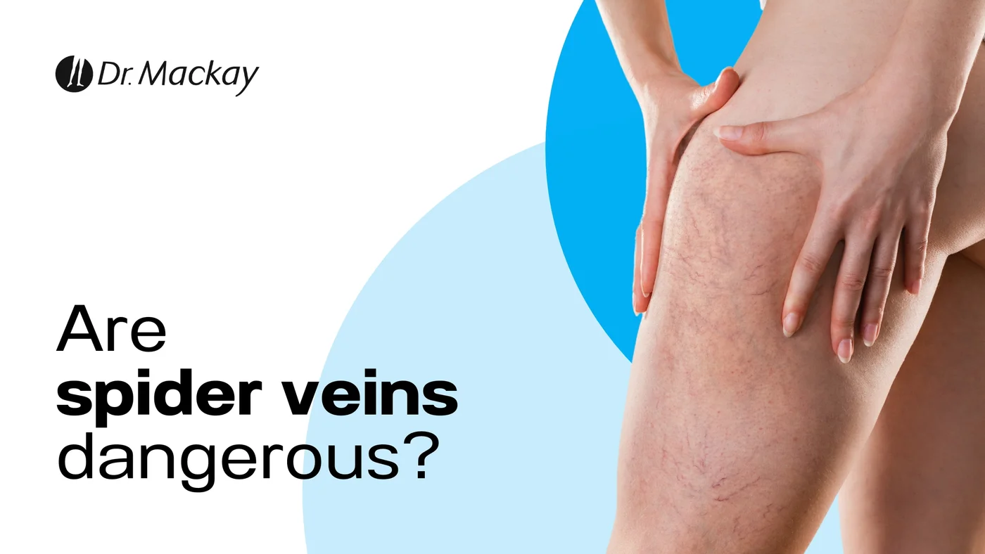 Are Spider Veins Dangerous?