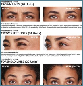 botox-juvederm patient before and after photos mackay (2)