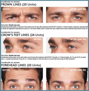 botox-juvederm patient before and after photos mackay