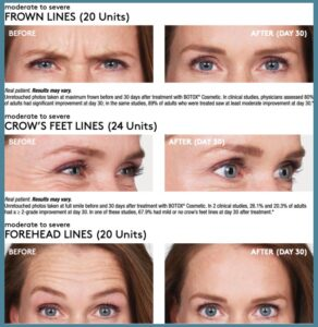 botox-juvederm patient before and after photos mackay (3)