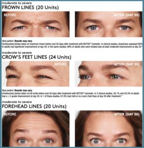 botox-juvederm patient before and after photos mackay (4)