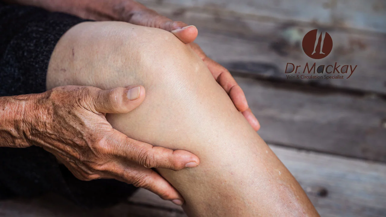 Varicose Vein Surgery Candidate?