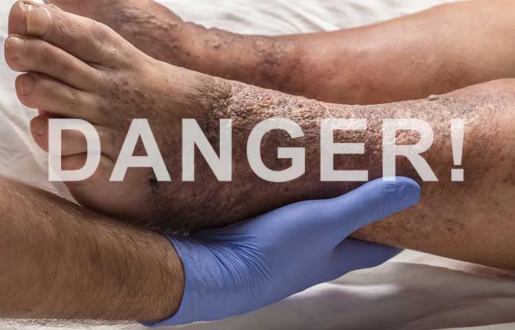 The Dangers of Varicose Veins