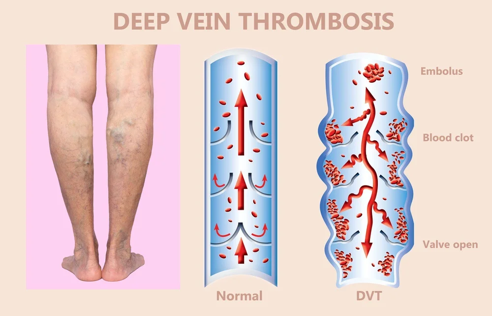 deep vein thrombosis illustration