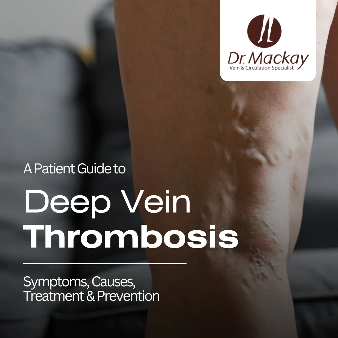 Deep Vein Thrombosis (DVT) Guide by Vein Surgeon Dr. Mackay IG Post
