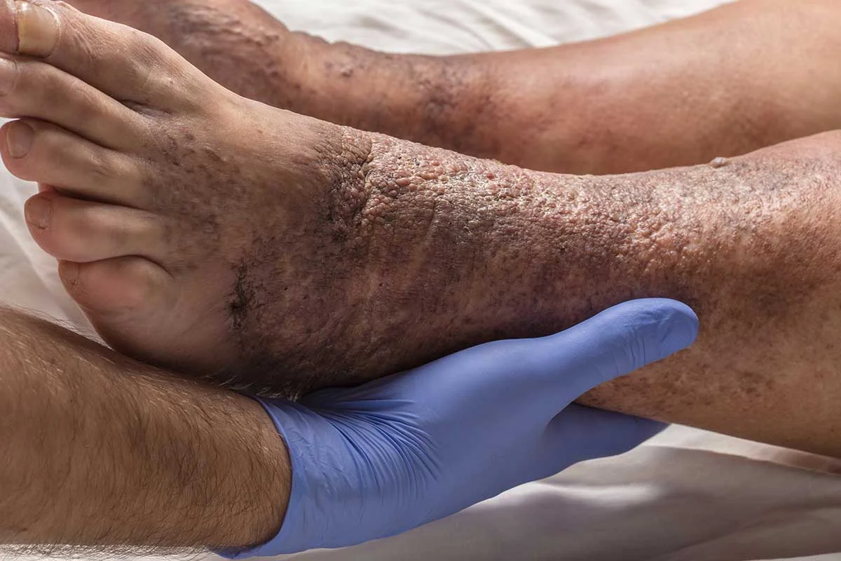Complications of Varicose Veins