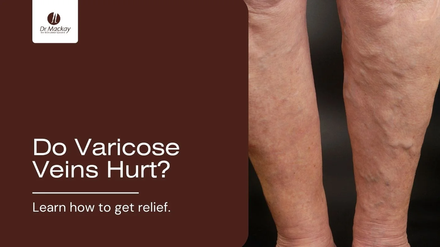 varicose veins leg that hurt