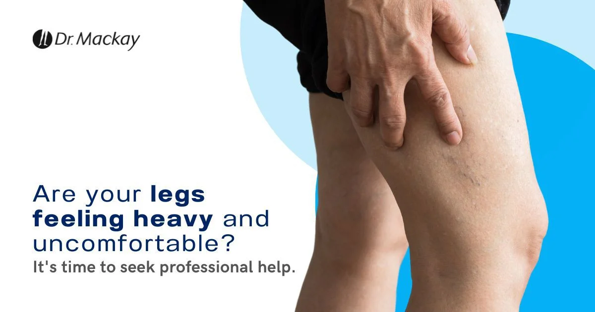 Effective Prevention & Treatment Tips for Varicose Veins
