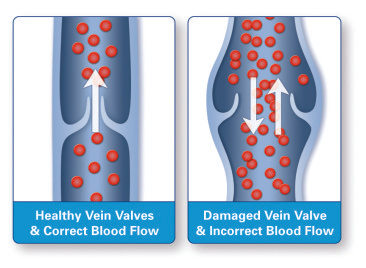 normal vs varicosed vein