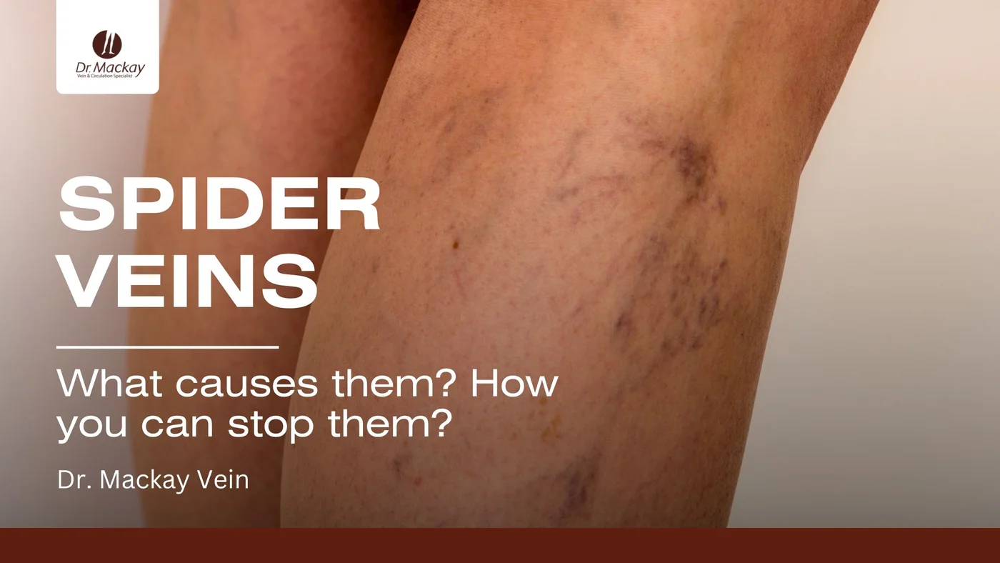 how can i stop spider veins
