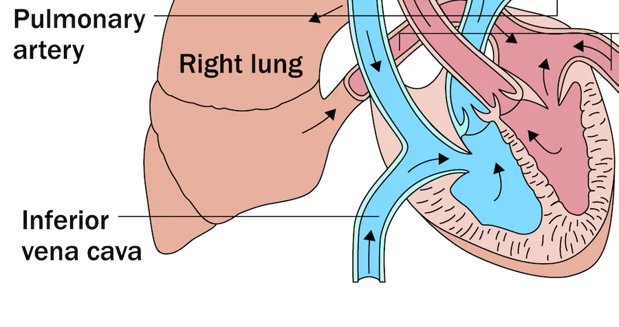 Do IVC Filters Clog?