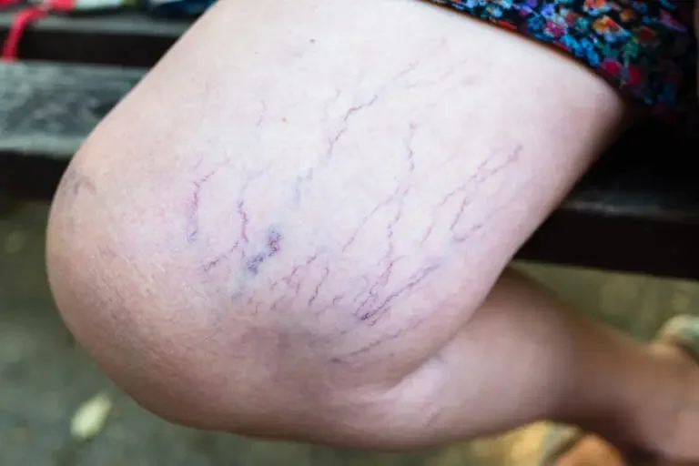 When to Know Spider Vein Removal Is Necessary?