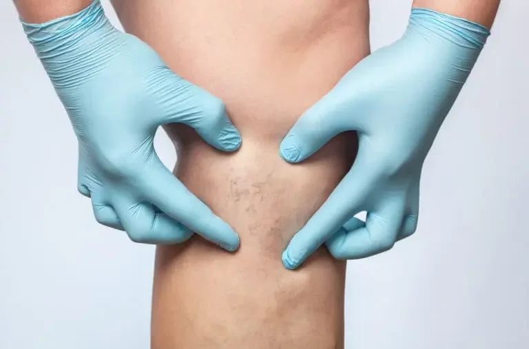 Spider Vein Removal: What You Need to Know