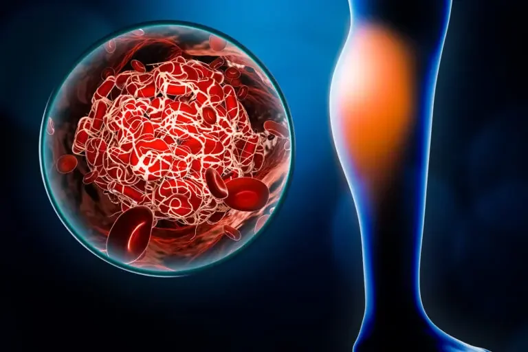Is It DVT? Common Symptoms
