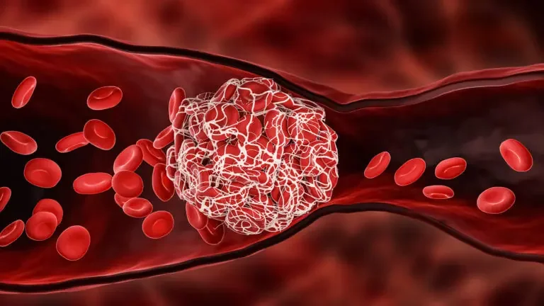 Thrombosed Veins: Causes and How to Avoid Them