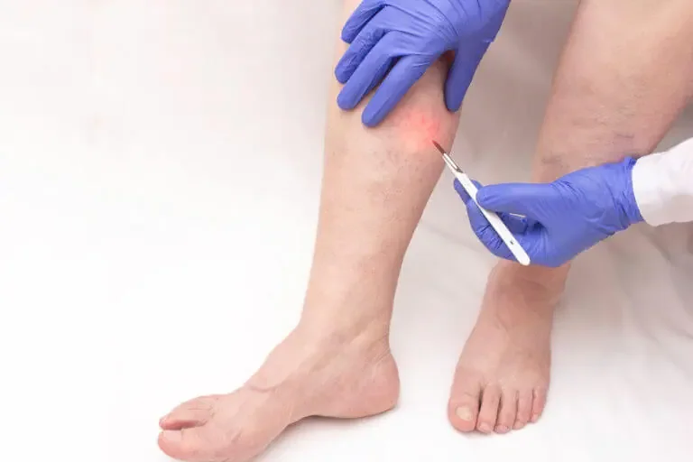 What to Expect After Sclerotherapy