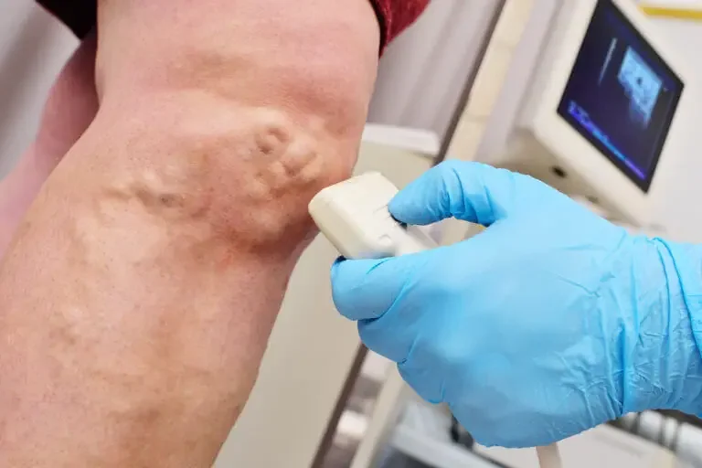 Five Basic Questions to Ask Your Vein Doctor